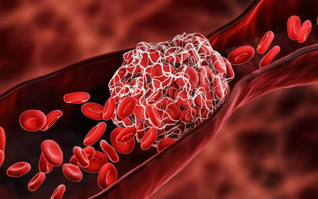 Blood Clots Due to Sedentary Lifestyle