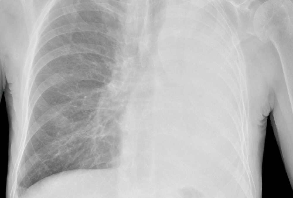 Airway Collapse During Anesthesia Induction