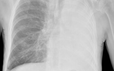 Airway Collapse During Anesthesia Induction