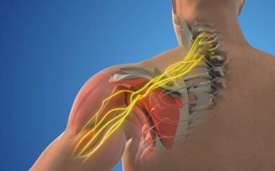 Neurological Complications from Nerve Blocks